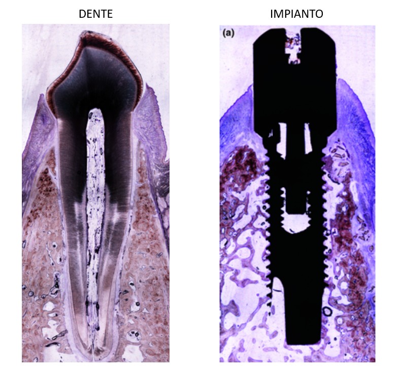 Differenza tra dente naturale e impianto dentale