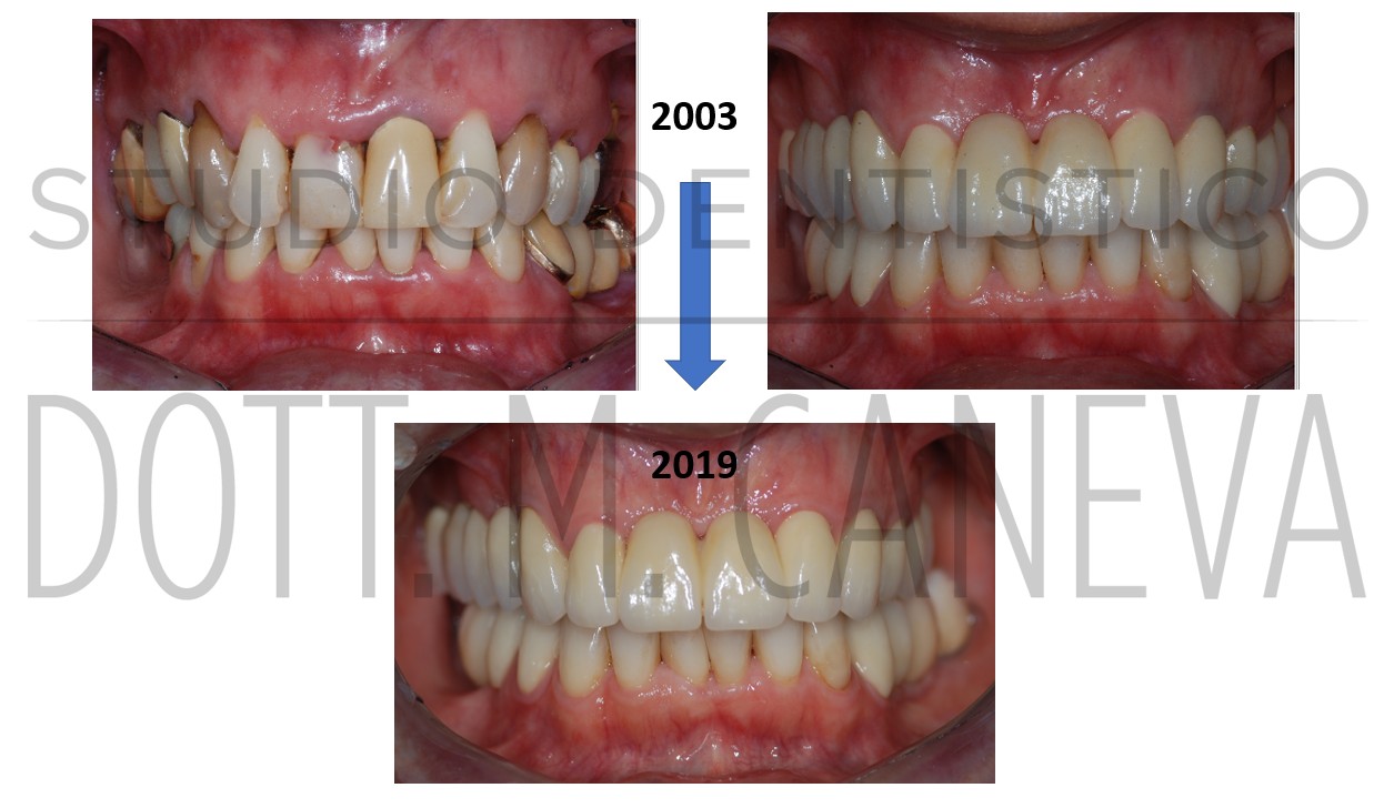 Impianti dentali: durata nel tempo con mantenimento