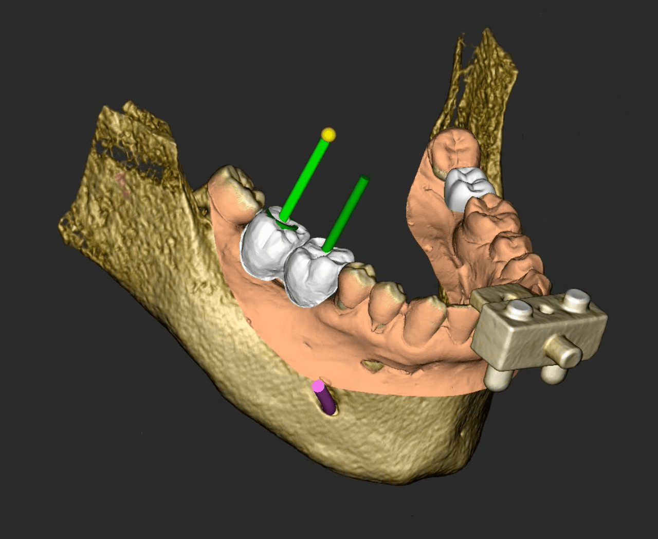 Simulazione digitale per la chirurgia guidata implantare nello Studio Dentistico Caneva a Trieste