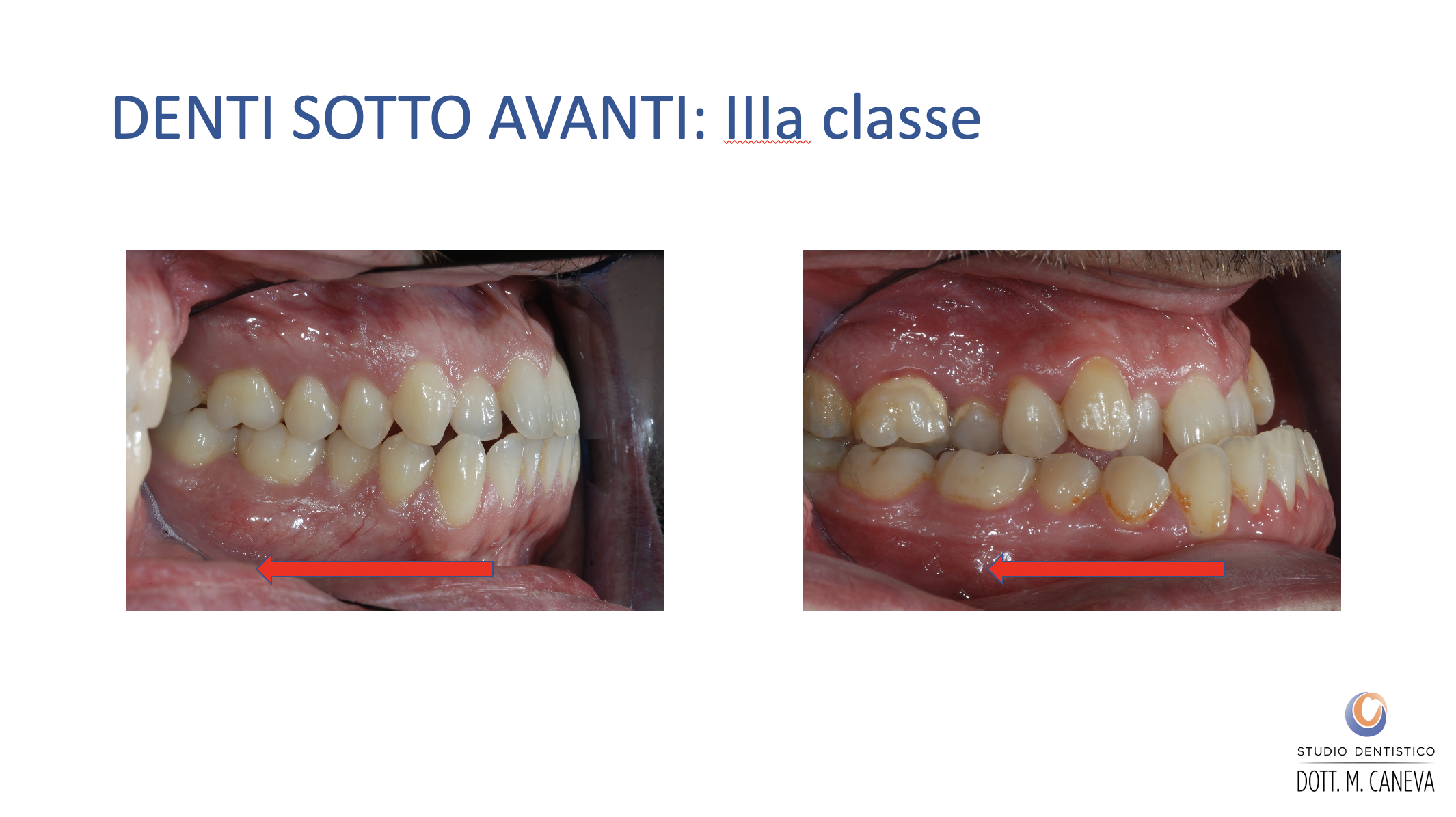 I Denti Si Spostano In Età Adulta Disallineamento dei Denti - Malocclusioni negli Adulti - Studio