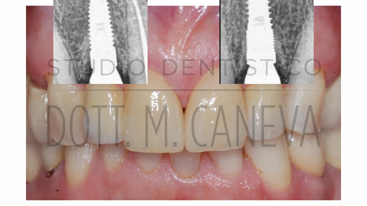 Dettaglio clinico: i laterali sono impianti ma l’estetica appare naturale