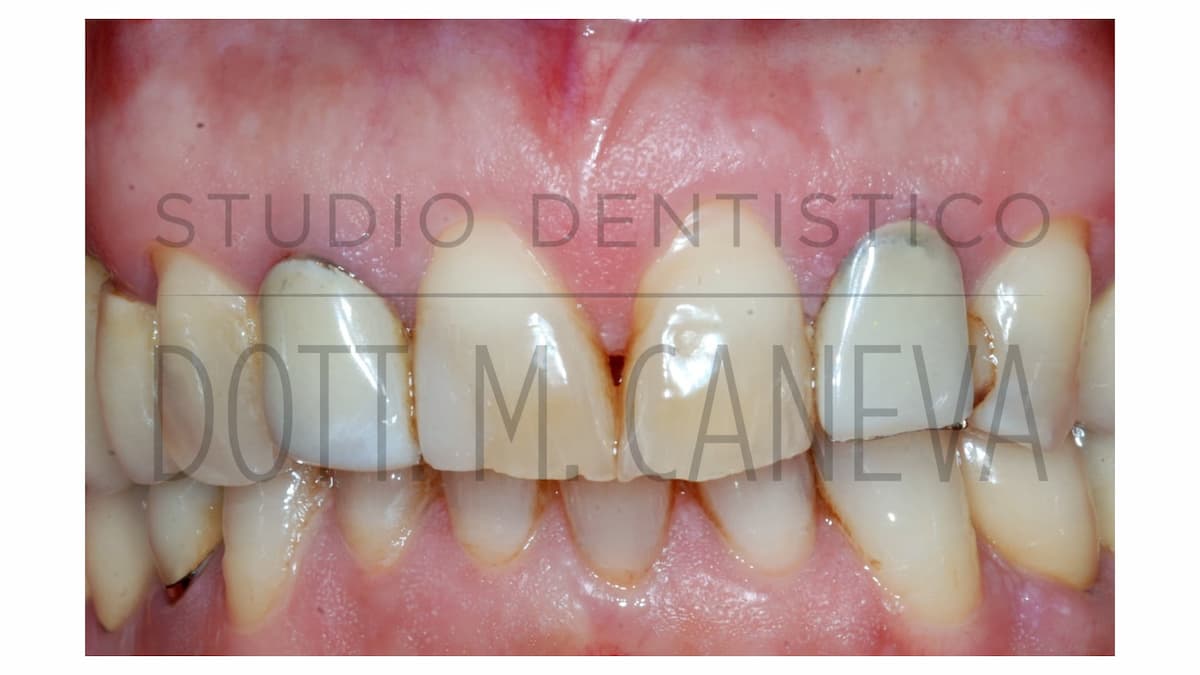 Prima del trattamento: sorriso con laterali compromessi