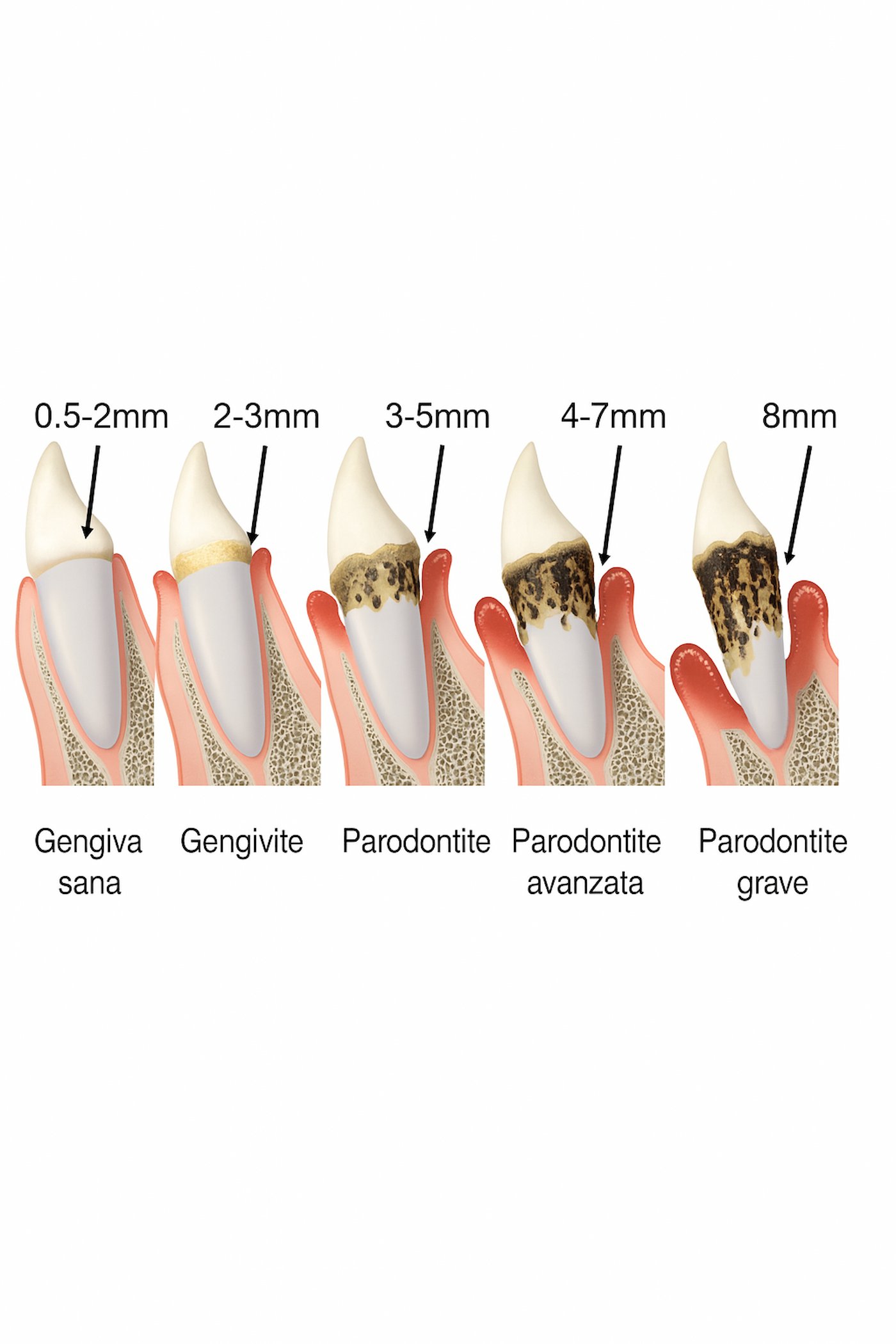 Evoluzione della parodontite: gengiva sana, gengivite, parodontite e perdita ossea progressiva con profondità di sondaggio