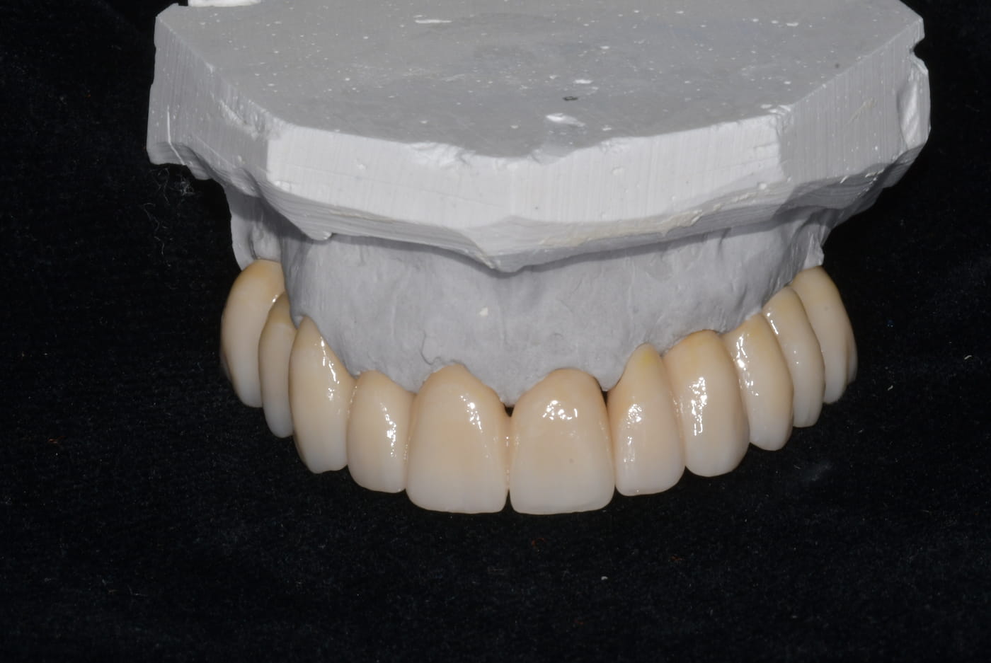 Protesi definitiva estetica in ceramica multilayer su modello