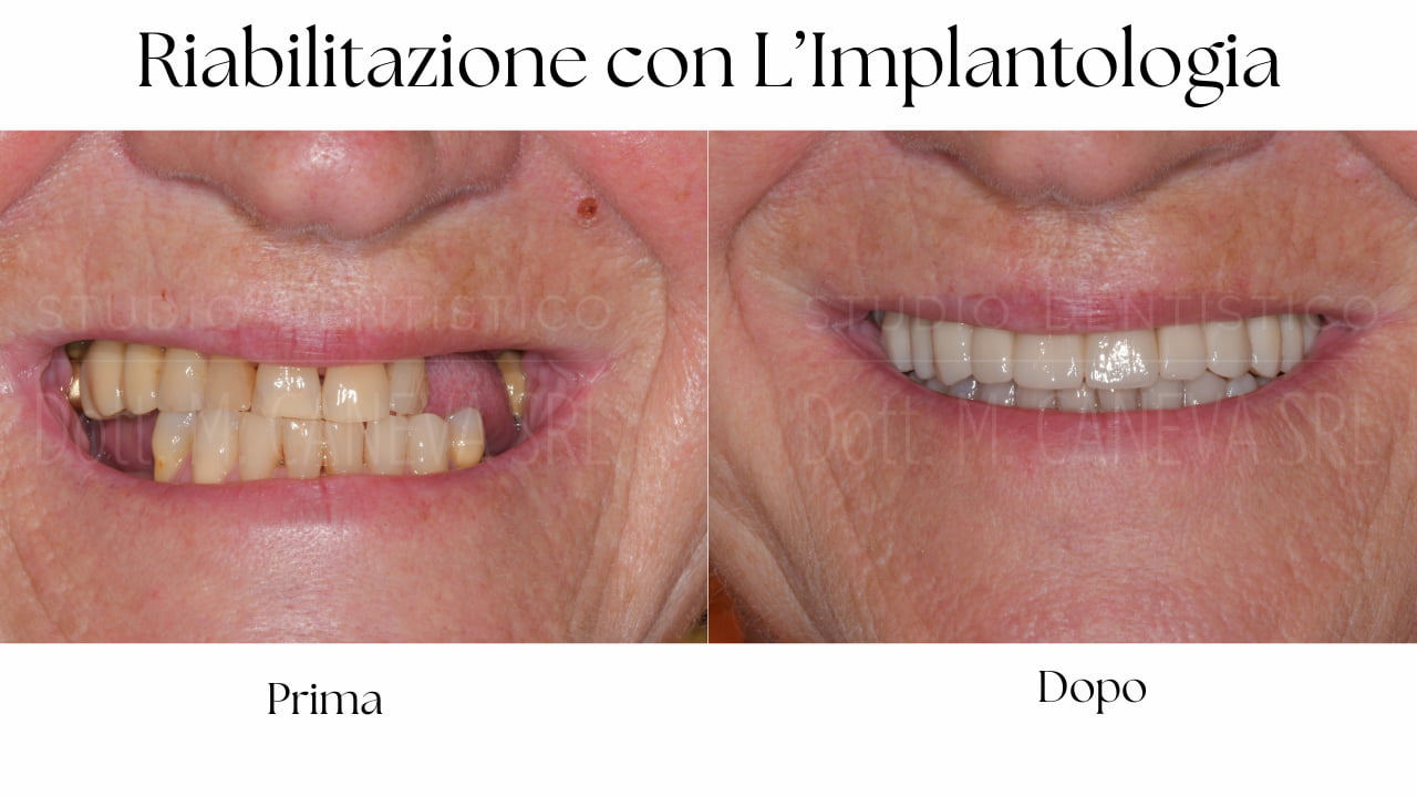 Riabilitazione completa con implantologia: sorriso prima e dopo – Studio Dentistico Caneva Trieste
