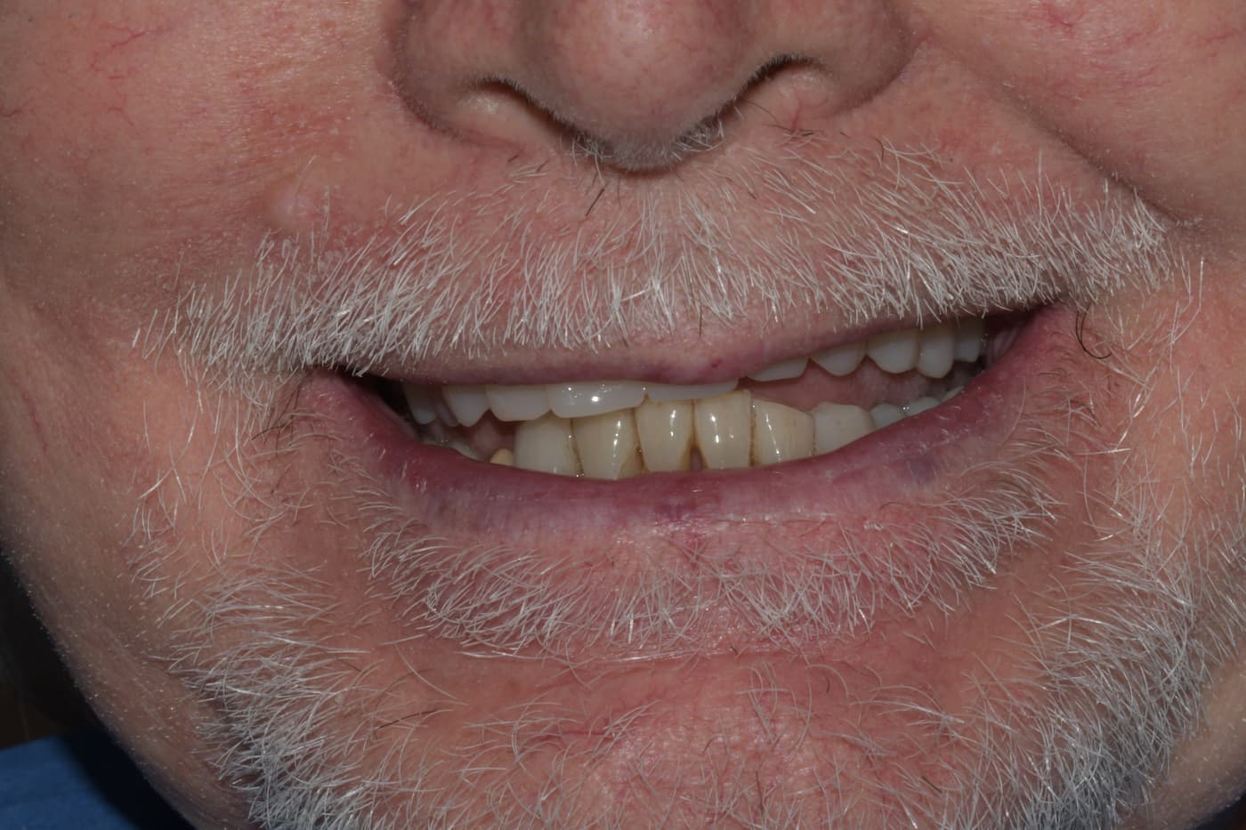 Sorriso di Lucio dopo la riabilitazione implantare avanzata del Dottor Marco Caneva, stabile e armonioso.