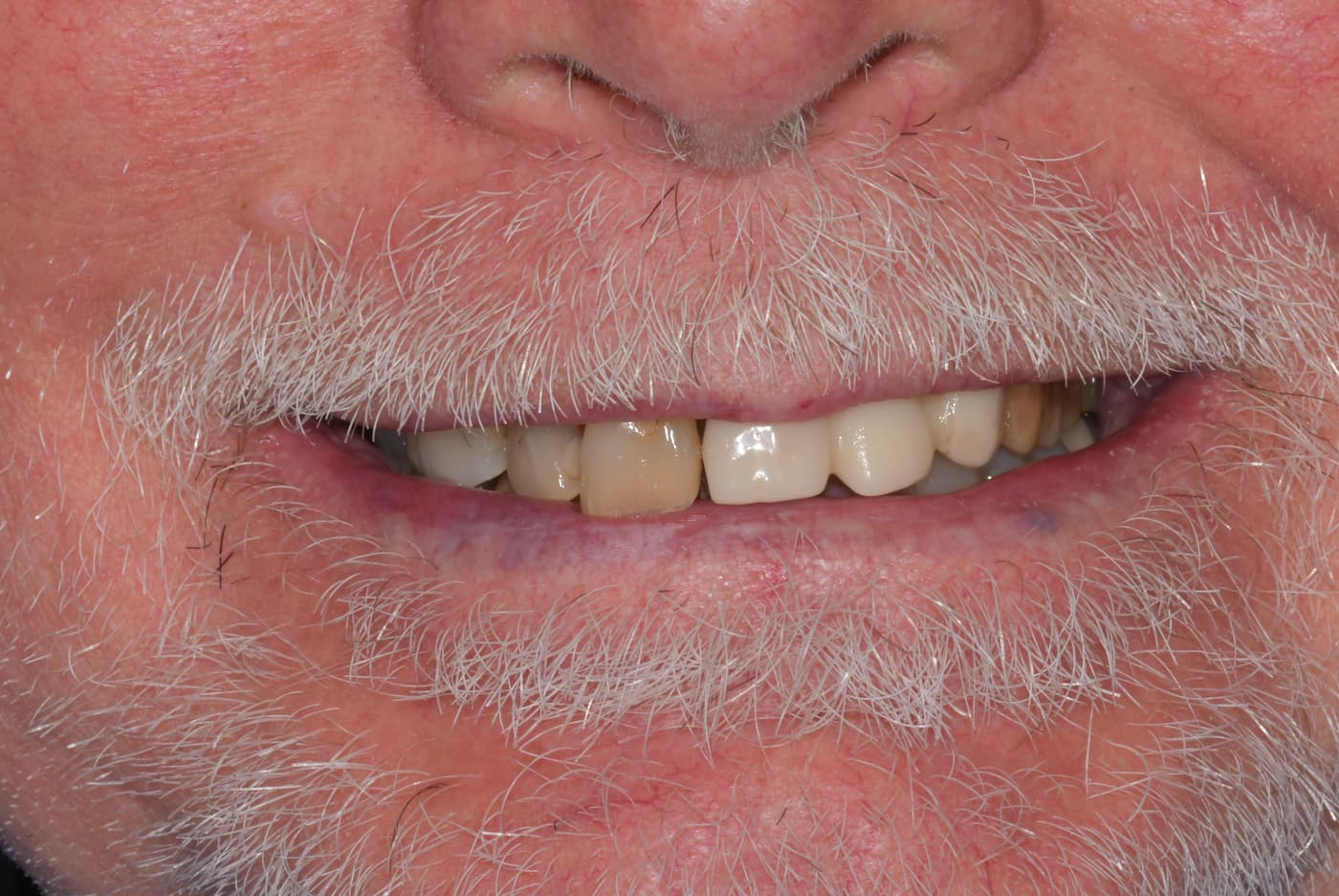 Sorriso di Lucio prima dell’implantologia, con denti mobili e discromie che compromettevano la masticazione.