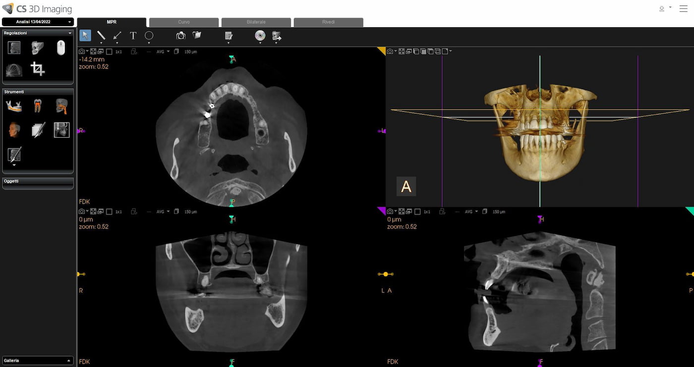 TAC Cone Beam 3D utilizzata per la diagnosi e la pianificazione implantare