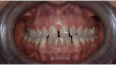 Cunei Dentali Cuneo Per Denti Interdentali, 50 Pezzi Denti Cuneo Interprossimale Strumento Per Materiale A Matrice Dentale Resistente Al Calore In Acciaio Inossidabile (S - Foto 6